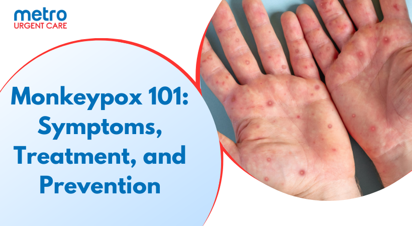 Monkeypox 101 Symptoms, Treatment, and Prevention