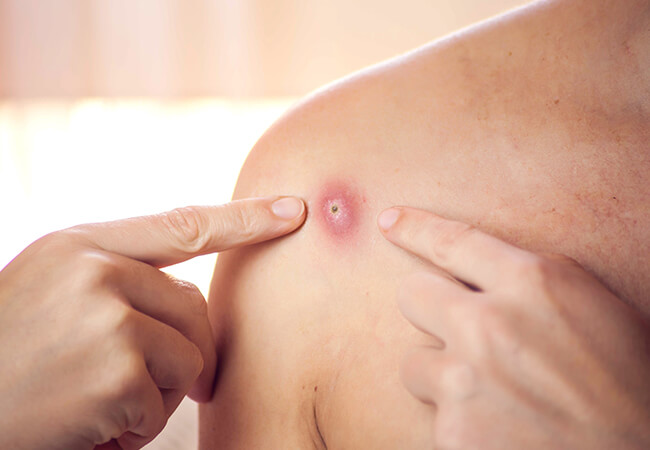 What is an Abscess, and What is a Cyst?