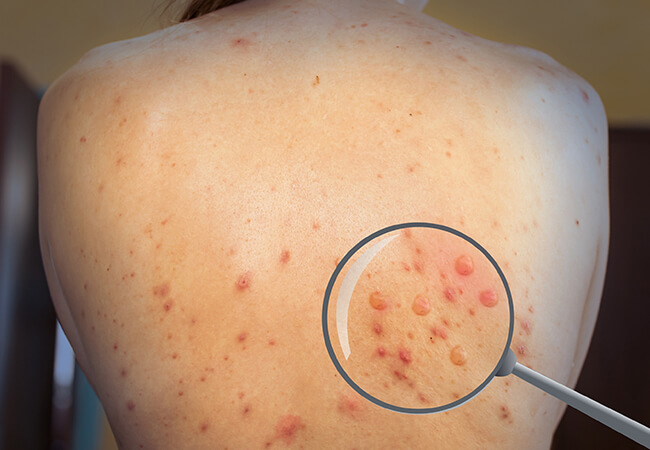 Monkeypox - What Is It?